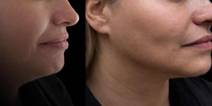 Foto: Lipopapada, procediminto estético Foto: Lipopapada, procediminto estético