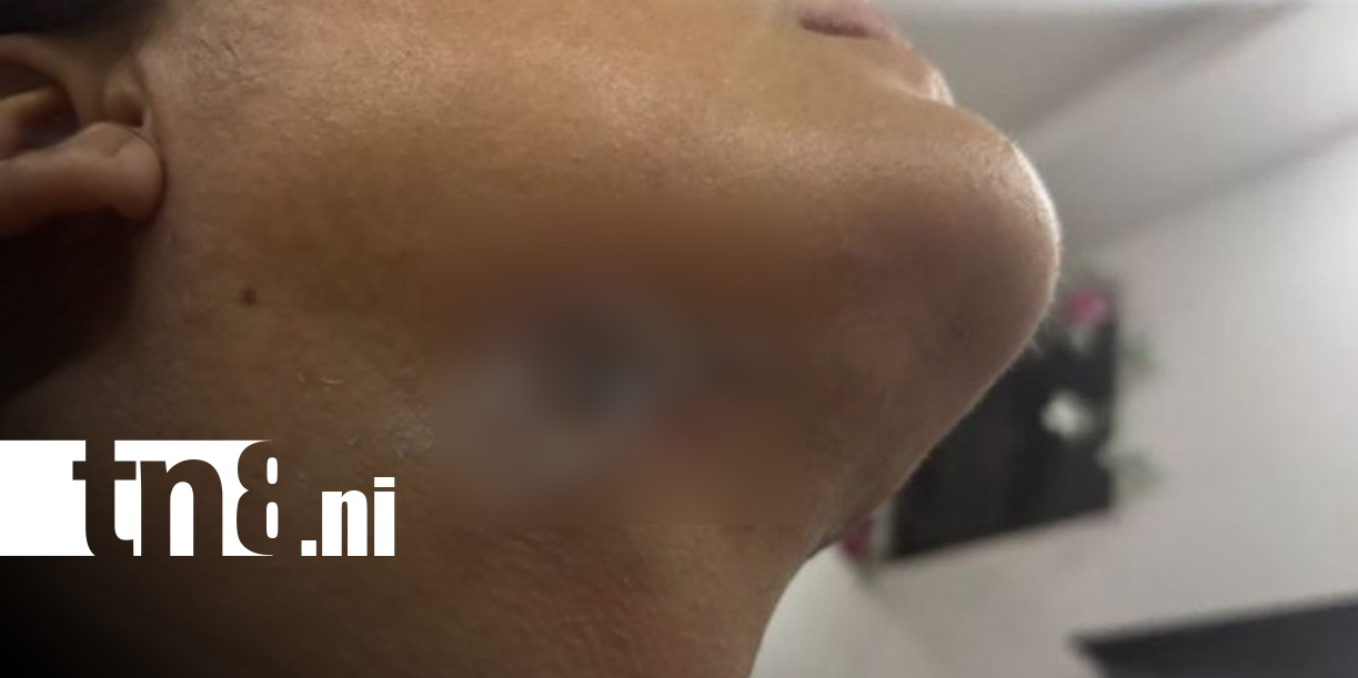 Foto: Víctima denuncia quemaduras tras cirugía de lipopapada en Managua / TN8