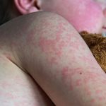 Foto: Guatemala enfrenta su peor brote de sarampión en casi tres décadas/Cortesía
