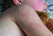 Foto: Guatemala enfrenta su peor brote de sarampión en casi tres décadas/Cortesía