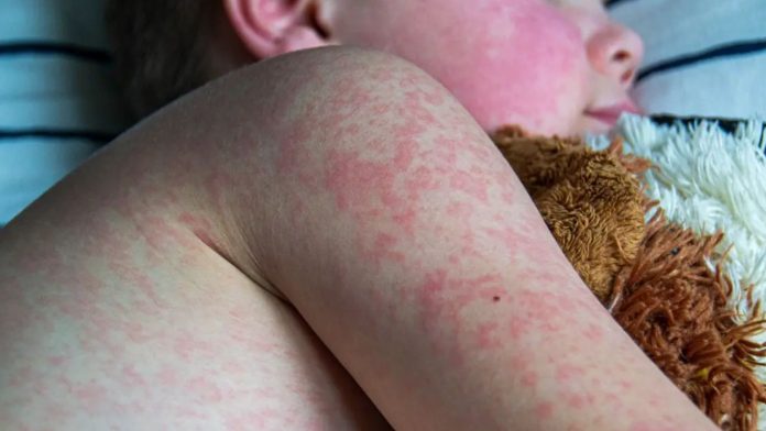Foto: Guatemala enfrenta su peor brote de sarampión en casi tres décadas/Cortesía