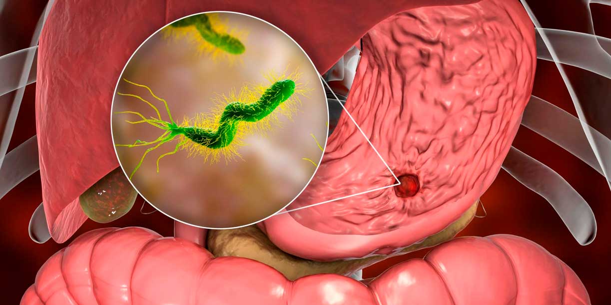 Foto: Helicobacter pylori enciende alerta científica/Cortesía