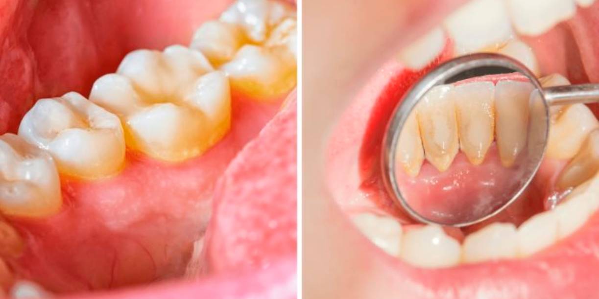 Foto: ¿Placa o sarro? Conoce la diferencia y cómo prevenirlos/Cortesía