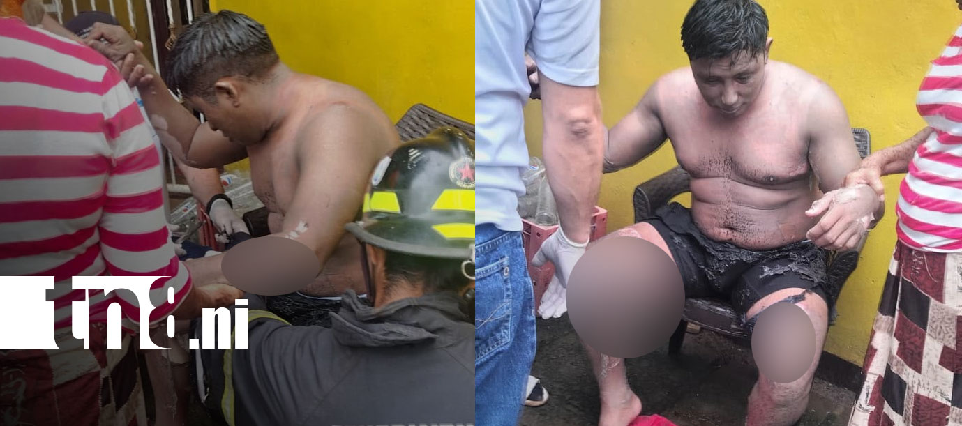 Foto: Gasolina y fogón: hombre sufre graves quemaduras en Masaya/TN8