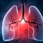 Cáncer de pulmón: estudio revela baja incidencia de eventos con nuevo tratamiento Foto: Nuevo estudio sobre cáncer de pulmón destaca resultados/Cortesía