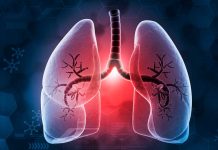 Cáncer de pulmón: estudio revela baja incidencia de eventos con nuevo tratamiento Foto: Nuevo estudio sobre cáncer de pulmón destaca resultados/Cortesía